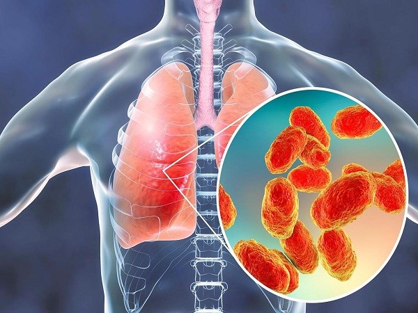 بیماری سینه پهلو یا ذاتالریه بیماری سینه پهلو یا ذاتالریه